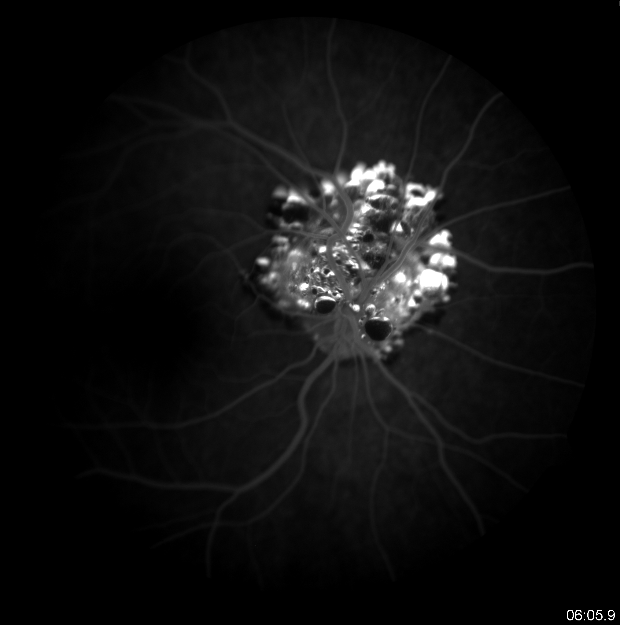 OS Angiography