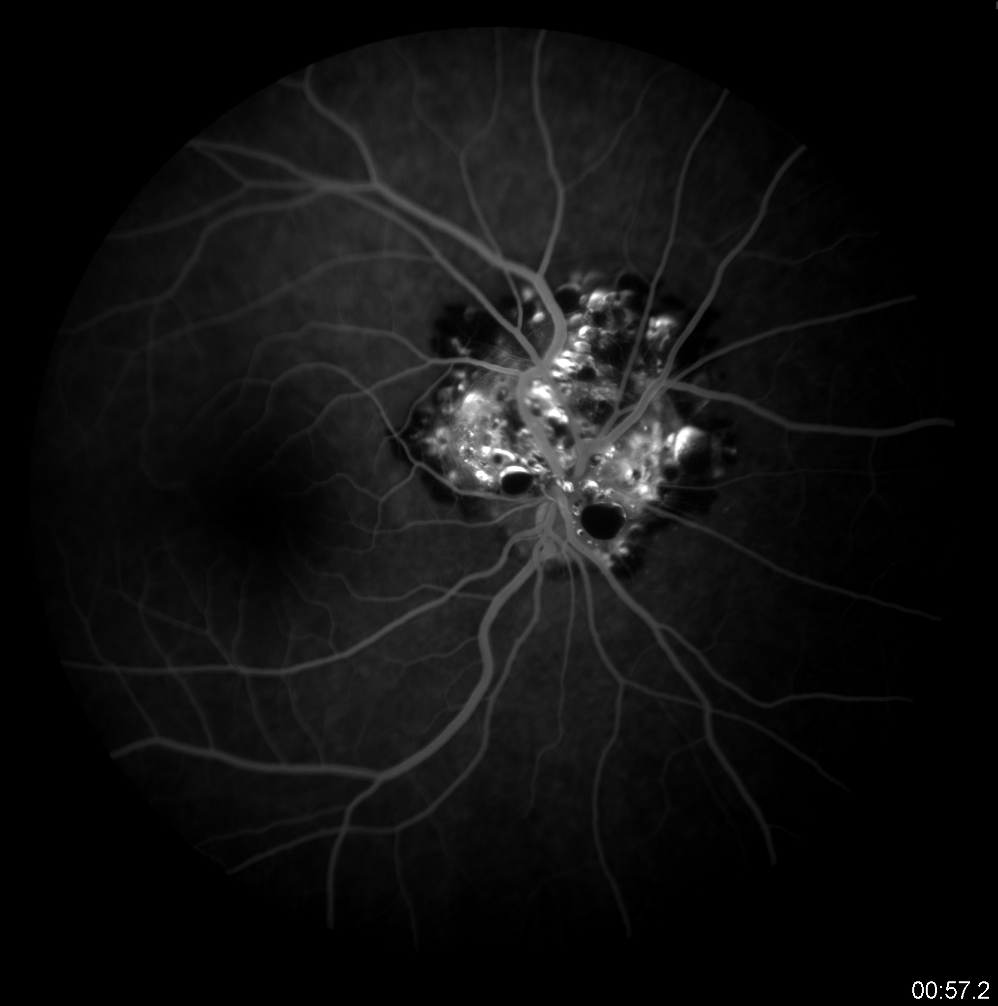 OD Angiography