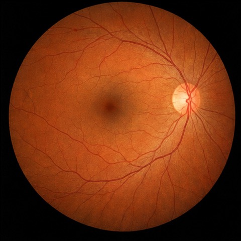OD Fundus