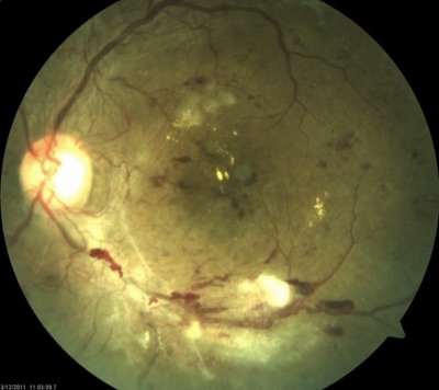 OS Fundus