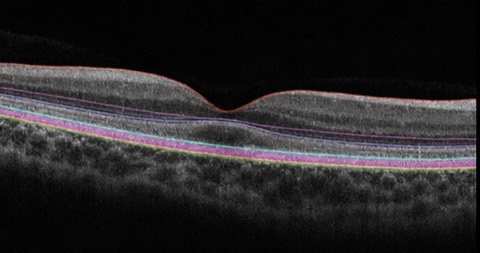 OCT Macula